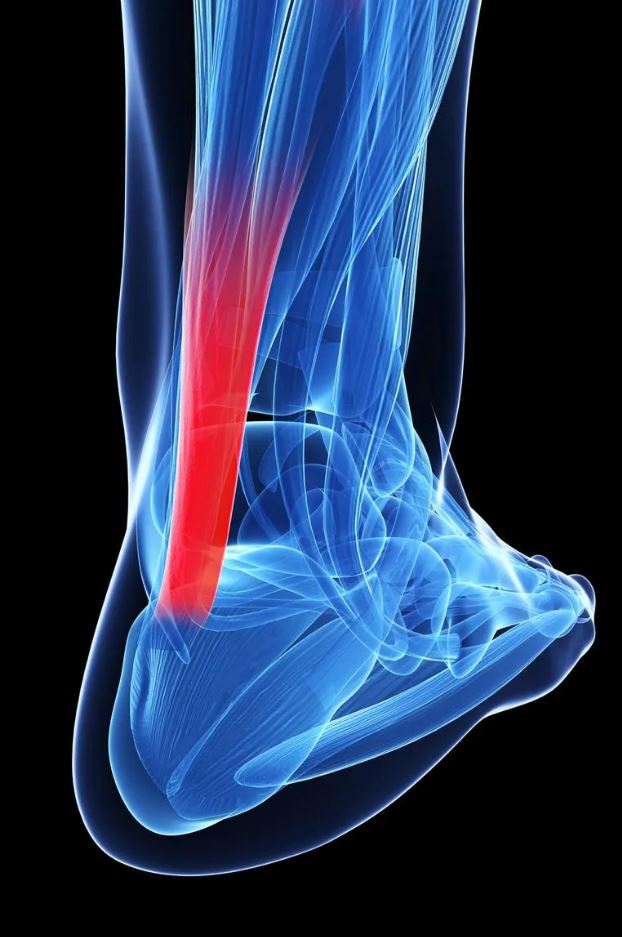 Can Orthotic Insoles Help Treat Achilles Tendonitis? – Fits Perfect