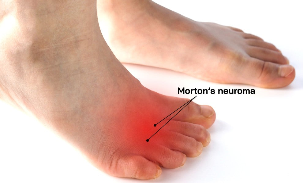 6 Exercises for Morton's Neuroma: Help Alleviate Your Foot Pain – Fits ...